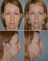 Денис Агапов. Эндоскопическая подтяжка лица