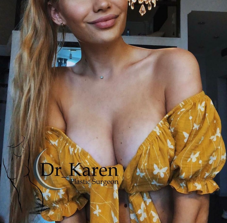 Пациентка пластического хирурга Карена Пайтяна после увеличения груди имплантами