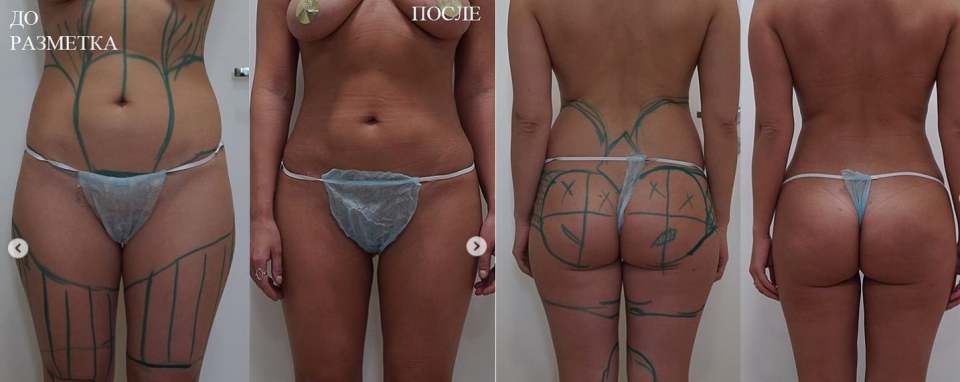 Пациентка доктора Арслана Пенаева до и после моделирования тела