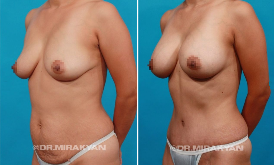 Пациентка до и после пластики живота и увеличения груди у доктора Гукаса Миракяна