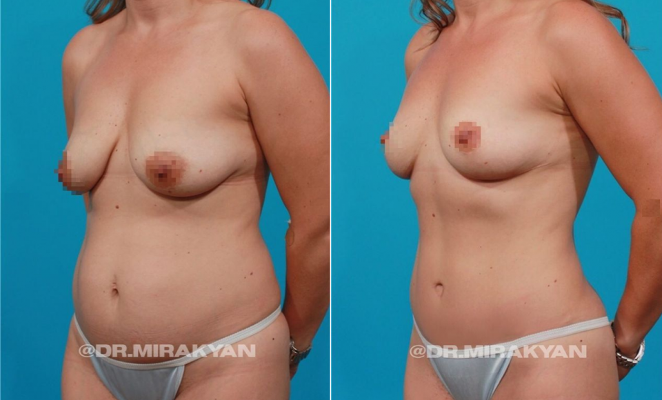 Пациентка до и после пластики живота и подтяжки груди у доктора Гукаса Миракяна