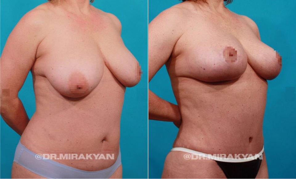 Пациентка до и после пластики живота и якорной подтяжки груди у доктора Гукаса Миракяна