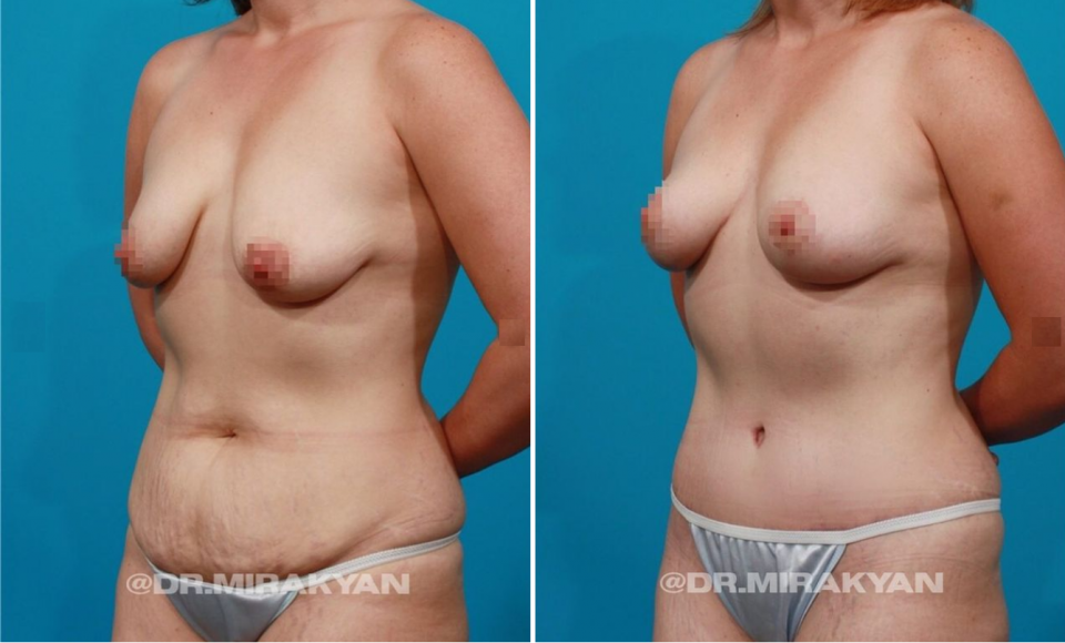 Пациентка до и после пластики живота и якорной мастопексии у доктора Гукаса Миракяна