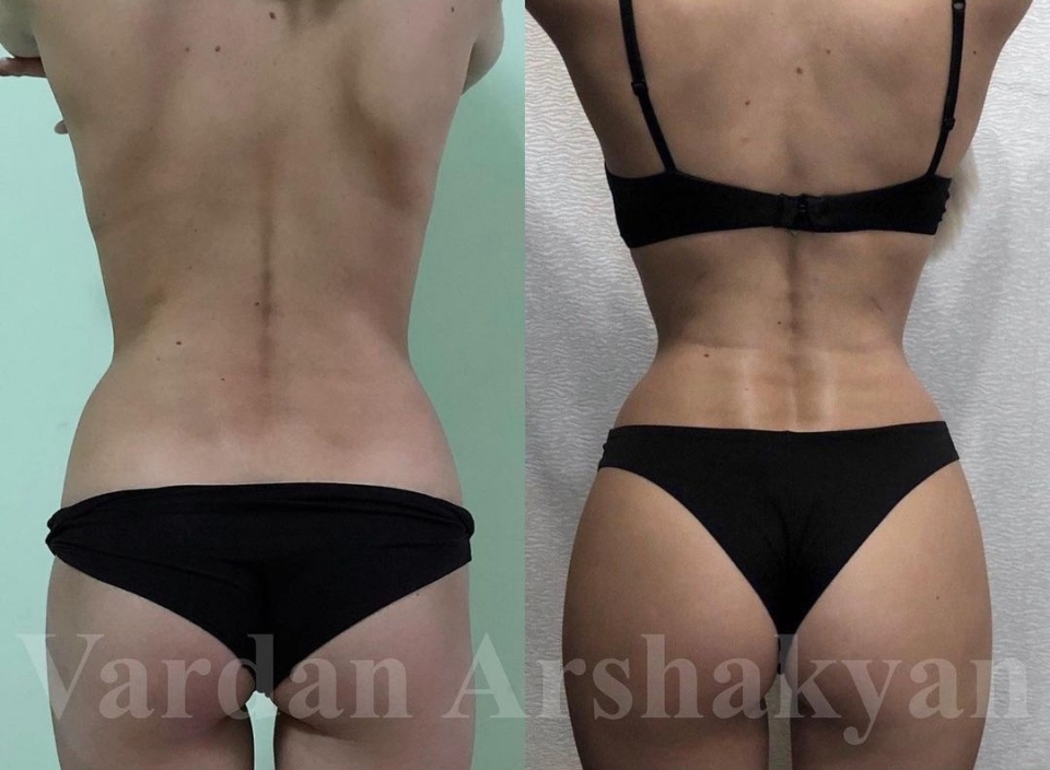 Пациентка до и после пластической операции по сужению талии у доктора Вардана Аршакяна