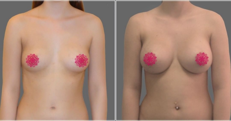 Пациентка доктора Рябцева до и после увеличения груди