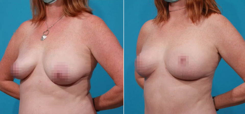 Пациентка пластического хирурга Гукаса Миракяна до и после якорной подтяжки груди