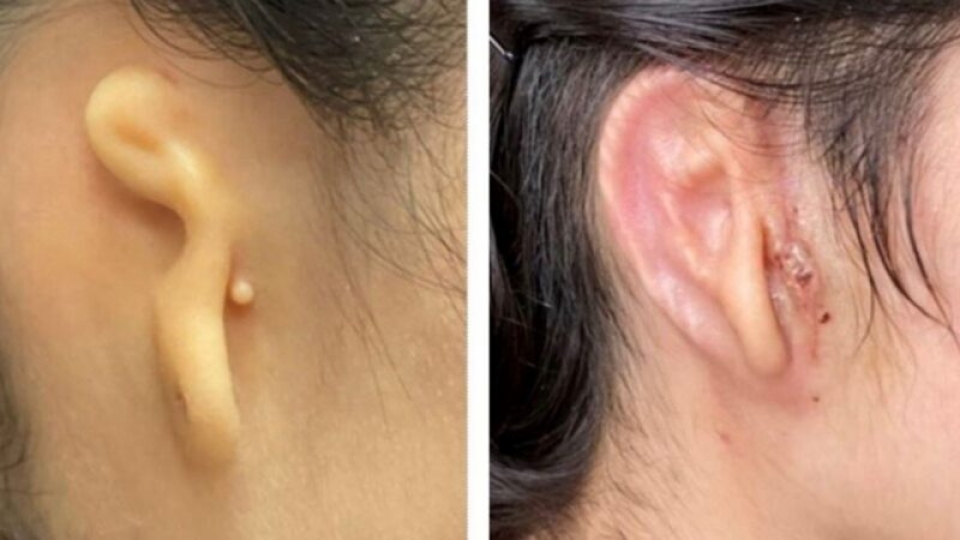 Женщине впервые в мире пересадили 3D-напечатанное ухо из ее собственных клеток