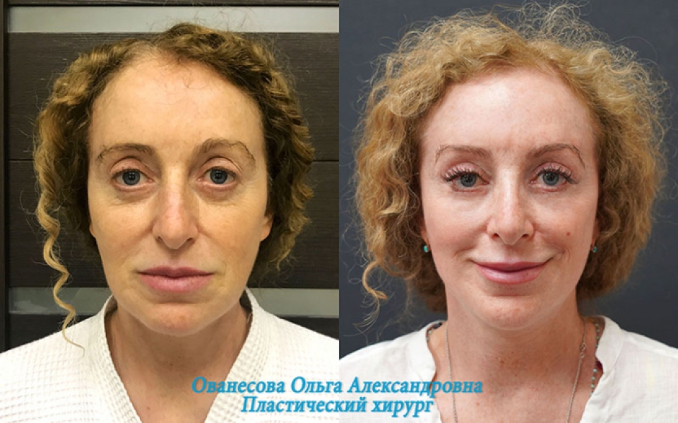 Пациентка доктора Ольги Ованесовой до и после комплексного омоложения лица и шеи