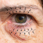 Эксперт рассказал, когда заживут шрамы после верхней блефаропластики