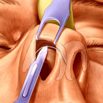 Функциональная ринохирургия