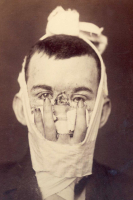 Реконструкция носа