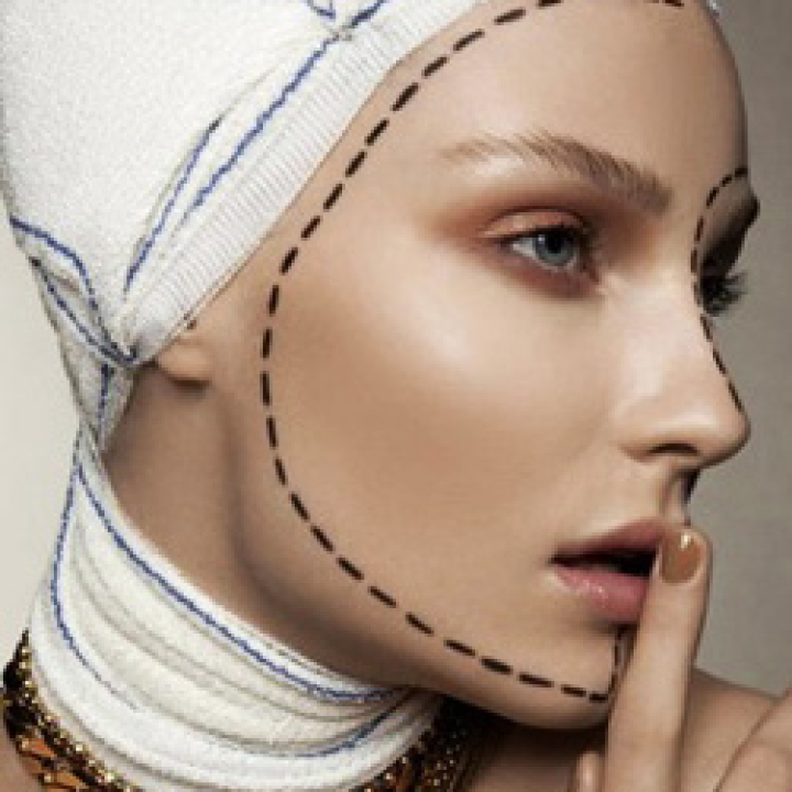 Фейслифтинг