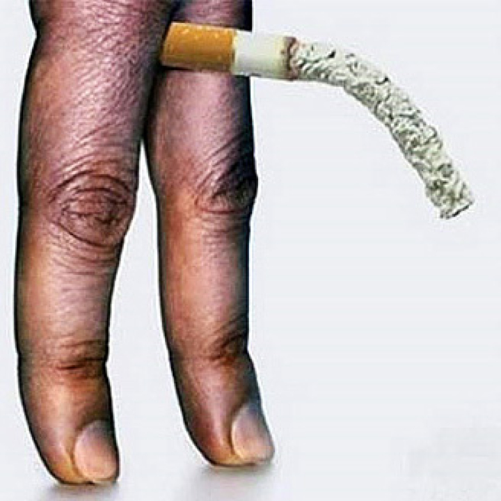 Эректильная дисфункция