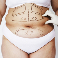 Абдоминопластика