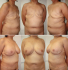 Реконструкция груди с помощью жира