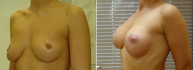 До и после пластики груди у Валерия Якимца