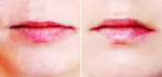 Perma Lip — увеличение губ с помощью силиконовых имплантов