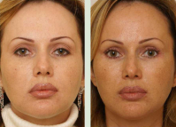 Endoskopitceskaya_podtyagka_litza_Malahovskaya