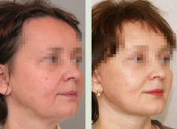 SMAS_lifting_Malahovskaya