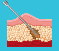 Лазерный липолиз