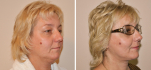 Пациентка доктора Шихирмана до и после тотального фэйслифтинга