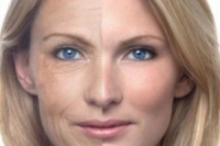 Липофилинг у Сергея Свиридова