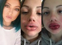 Флешмоб, посвященный губам Кайли Дженнер