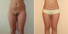 До и после радиочастотной липосакции живота и бедер у Светланы Пшонкиной