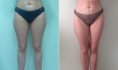 До и после радиочастотной липосакции бедер, ягодиц, живота и спины у Светланы Пшонкиной