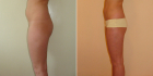 До и после радиочастотной липосакции живота и бедер у Светланы Пшонкиной