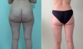 До и после радиочастотной липосакции бедер, ягодиц, живота и спины у Светланы Пшонкиной