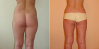 До и после радиочастотной липосакции живота и бедер у Светланы Пшонкиной