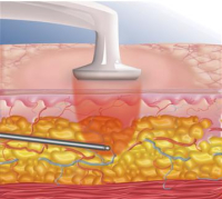 RF-липосакция