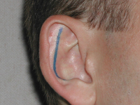 Предоперационная разметка