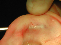 Введение в разрез хряща ножа для выполнения насечек на передней поверхности противозавитка