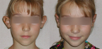 Авторский метод коррекции ушей от пластического хирурга Андрея Гурьянова