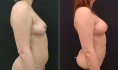 До и после липофилинга груди у Владимира Зленко