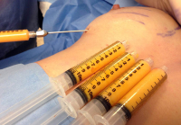 Липофилинг груди