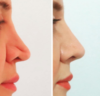 Ринопластика. Пластический хирург Али Алиев