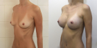 До и после маммопластики у Валерия Стайсупова