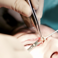 Блефаропластика у Валерия Стайсупова