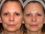 Пациентка доктора Абрамова до и после безоперационной подтяжки лица методом липолифтинга
