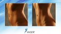 До и после коррекции фигуры с помощью системы VASER LIPO