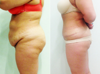 Результаты абдоминопластики при диастазе