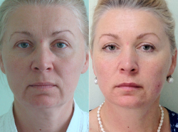 До и после Силуэт Лифт