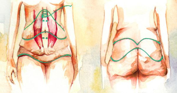 Бодилифтинг