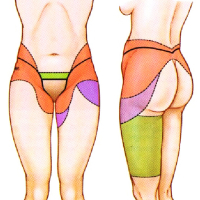 Торсопластика