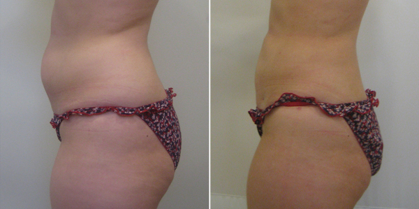 Фото до и после радиочастотной липосакции BodyTite у Светланы Пшонкиной