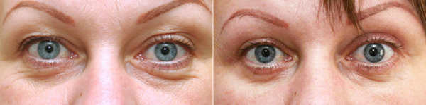 Фото до и после блефаропластики у Александра Жукова