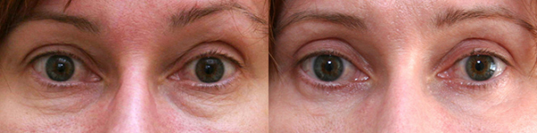 Фото до и после лазерной блефаропластики у Александра Жукова